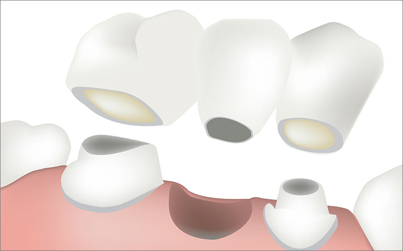 Dental Crowns & Dental Bridges
